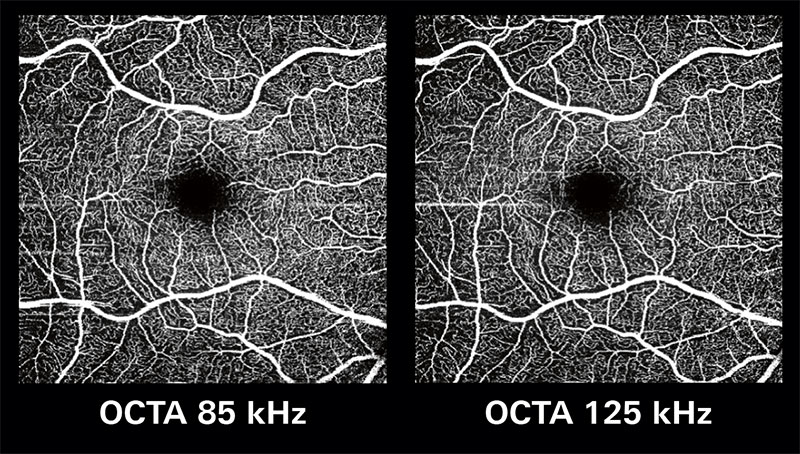 High resolution image comparison of OCTA at 85 kHz and 125 kHz,